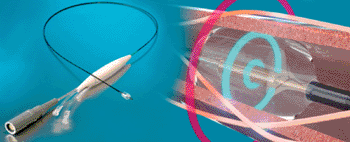 Image: The Paradise OTW ultrasound device (Photo courtesy of ReCor Medical).